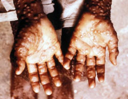 Small Poxjpg — Viruses And Diseases option 17