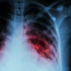 Turburculosisjpg — Viruses And Diseases option 19